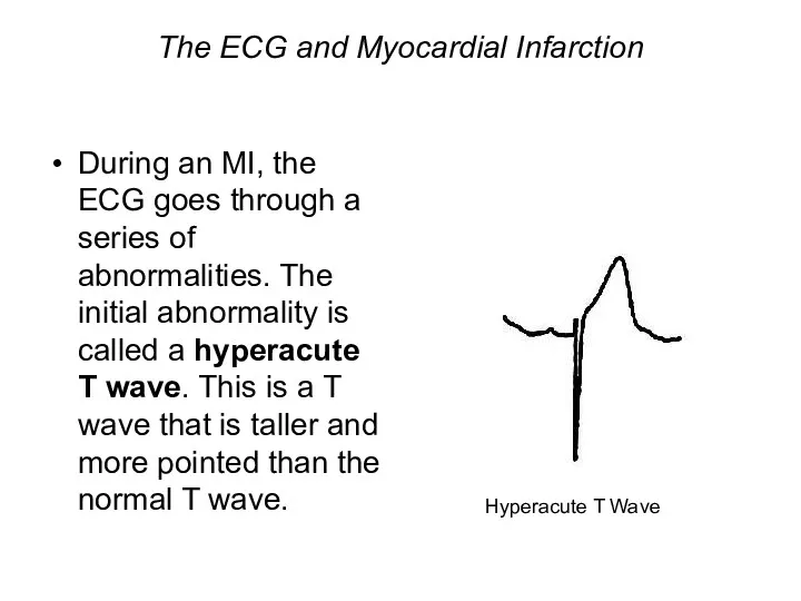 The ECG and Myocardial Infarction During an MI, the ECG goes through a