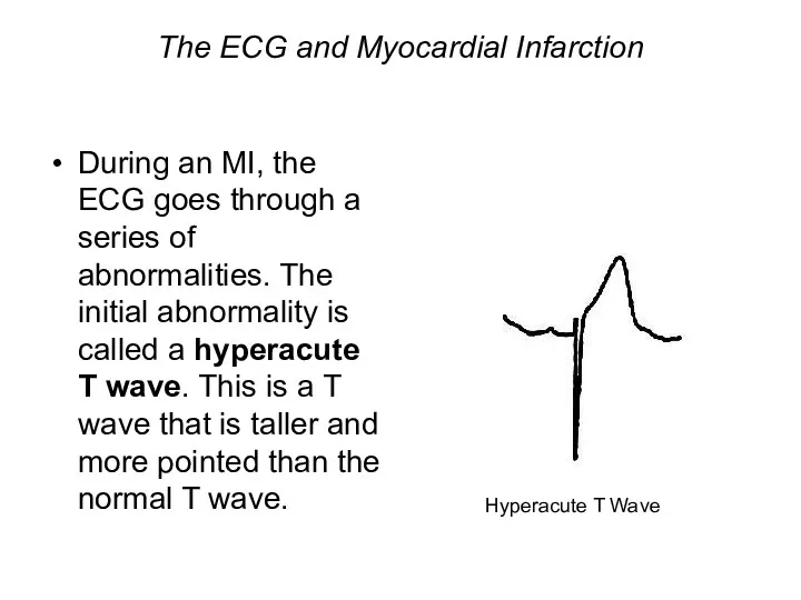 The ECG and Myocardial Infarction During an MI, the ECG