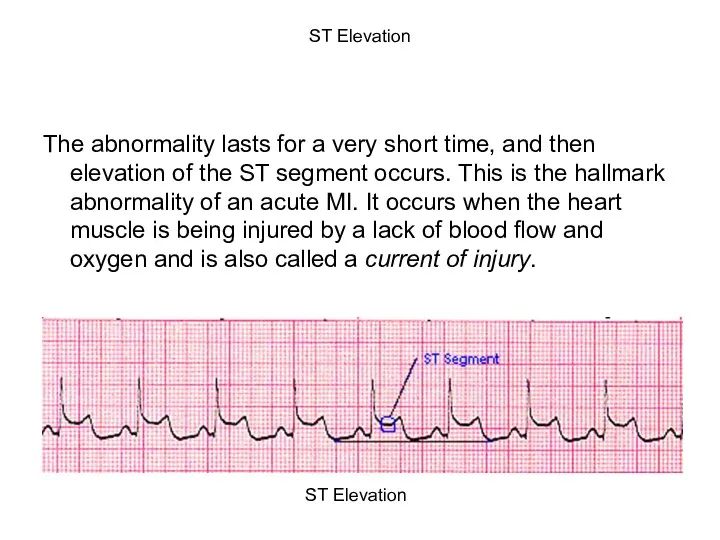 ST Elevation The abnormality lasts for a very short time, and then elevation