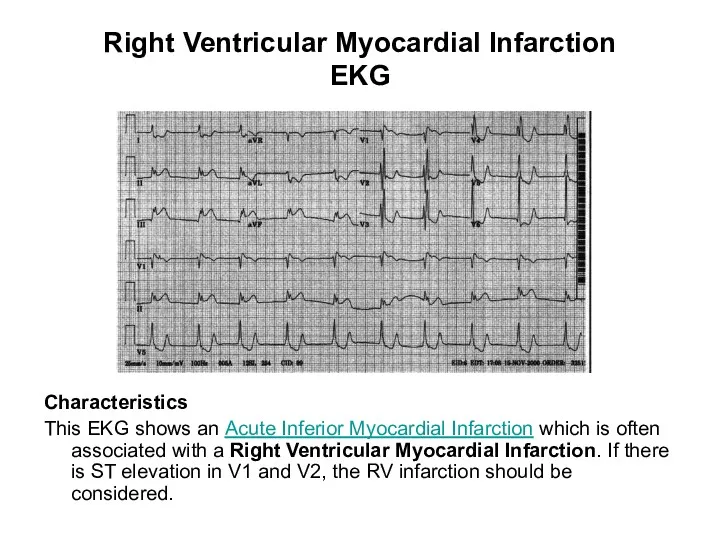 Right Ventricular Myocardial Infarction EKG Characteristics This EKG shows an Acute Inferior Myocardial