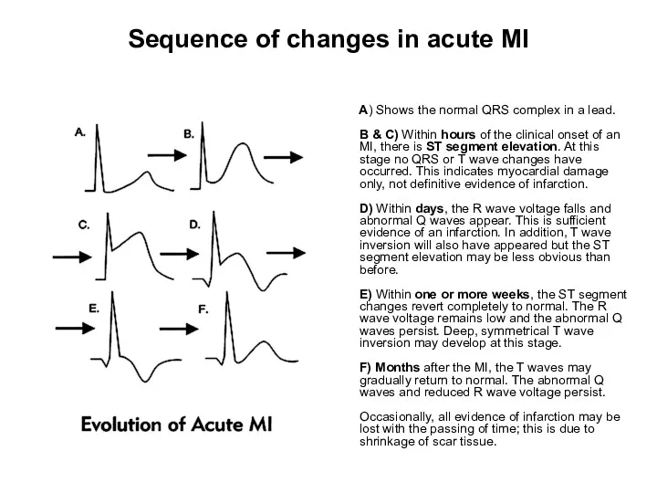 Sequence of changes in acute MI A) Shows the normal QRS complex in