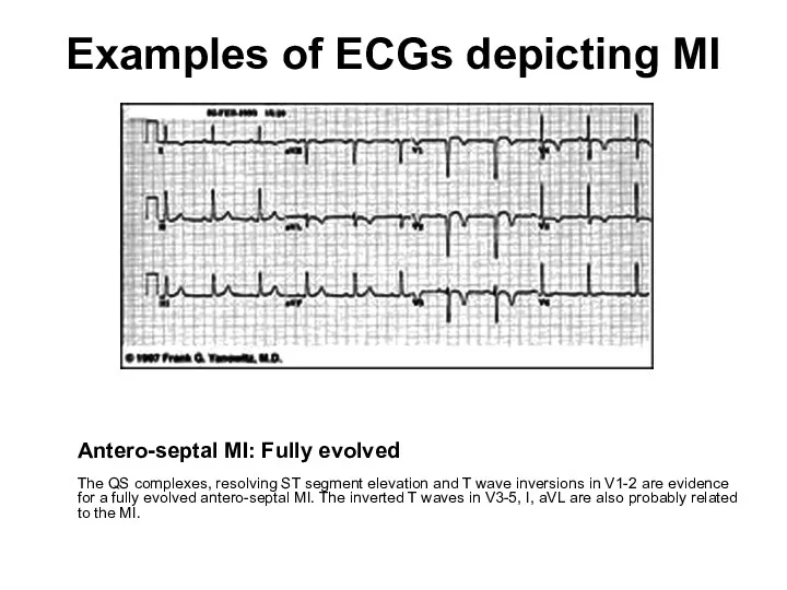 Examples of ECGs depicting MI Antero-septal MI: Fully evolved The QS complexes, resolving