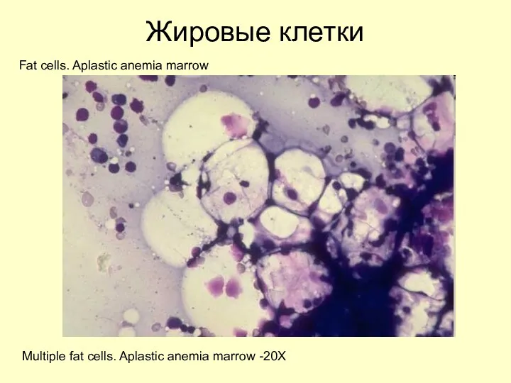 Жировые клетки Fat cells. Aplastic anemia marrow Multiple fat cells. Aplastic anemia marrow -20X