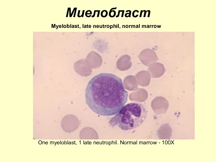 Миелобласт Myeloblast, late neutrophil, normal marrow One myeloblast, 1 late neutrophil. Normal marrow - 100X