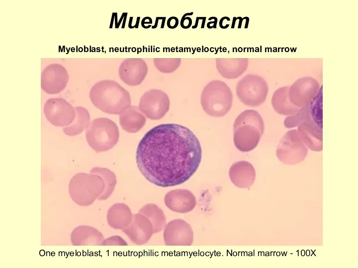 Миелобласт Myeloblast, neutrophilic metamyelocyte, normal marrow One myeloblast, 1 neutrophilic metamyelocyte. Normal marrow - 100X