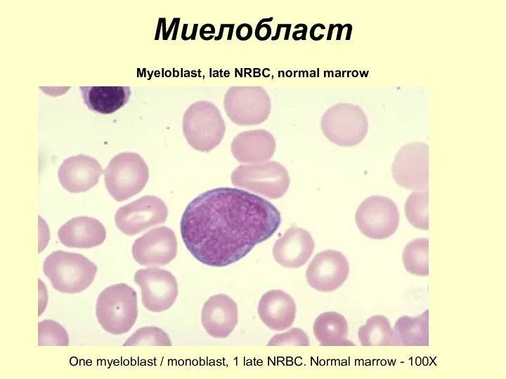 Миелобласт Myeloblast, late NRBC, normal marrow One myeloblast / monoblast,
