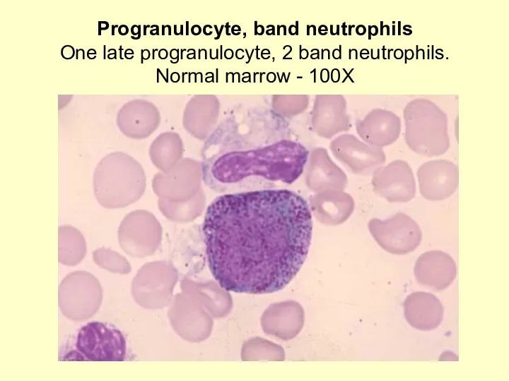 Progranulocyte, band neutrophils One late progranulocyte, 2 band neutrophils. Normal marrow - 100X