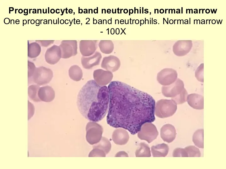 Progranulocyte, band neutrophils, normal marrow One progranulocyte, 2 band neutrophils. Normal marrow - 100X