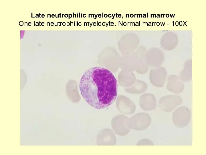 Late neutrophilic myelocyte, normal marrow One late neutrophilic myelocyte. Normal marrow - 100X