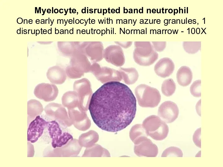 Myelocyte, disrupted band neutrophil One early myelocyte with many azure