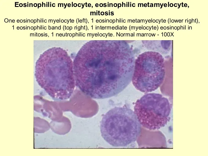 Eosinophilic myelocyte, eosinophilic metamyelocyte, mitosis One eosinophilic myelocyte (left), 1