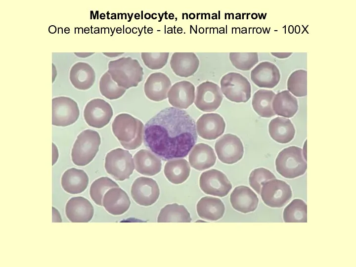 Metamyelocyte, normal marrow One metamyelocyte - late. Normal marrow - 100X