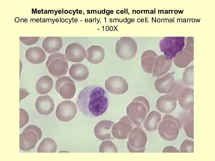 Metamyelocyte, smudge cell, normal marrow One metamyelocyte - early, 1 smudge cell. Normal marrow - 100X