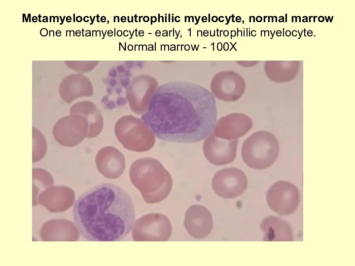 Metamyelocyte, neutrophilic myelocyte, normal marrow One metamyelocyte - early, 1 neutrophilic myelocyte. Normal marrow - 100X