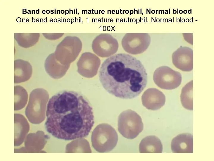 Band eosinophil, mature neutrophil, Normal blood One band eosinophil, 1 mature neutrophil. Normal blood - 100X