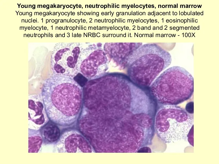 Young megakaryocyte, neutrophilic myelocytes, normal marrow Young megakaryocyte showing early