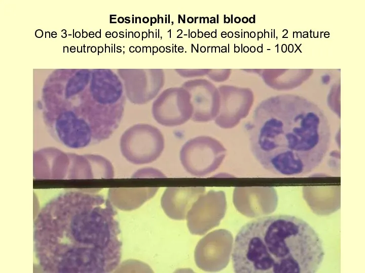 Eosinophil, Normal blood One 3-lobed eosinophil, 1 2-lobed eosinophil, 2