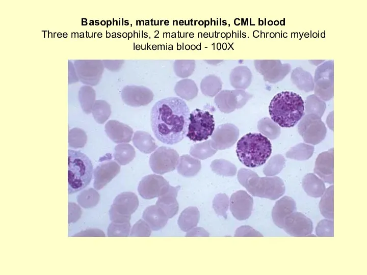 Basophils, mature neutrophils, CML blood Three mature basophils, 2 mature