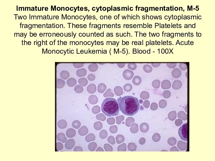 Immature Monocytes, cytoplasmic fragmentation, M-5 Two Immature Monocytes, one of