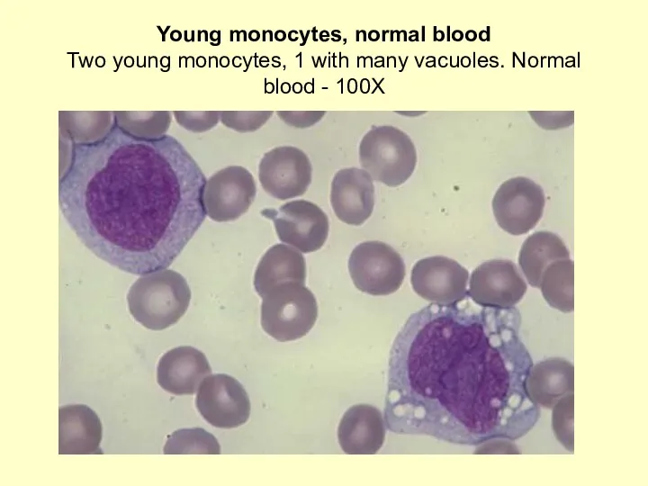 Young monocytes, normal blood Two young monocytes, 1 with many vacuoles. Normal blood - 100X