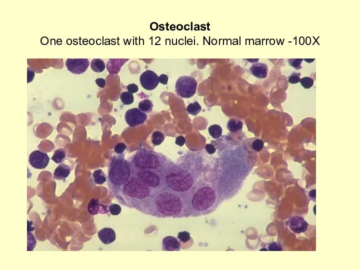 Osteoclast One osteoclast with 12 nuclei. Normal marrow -100X