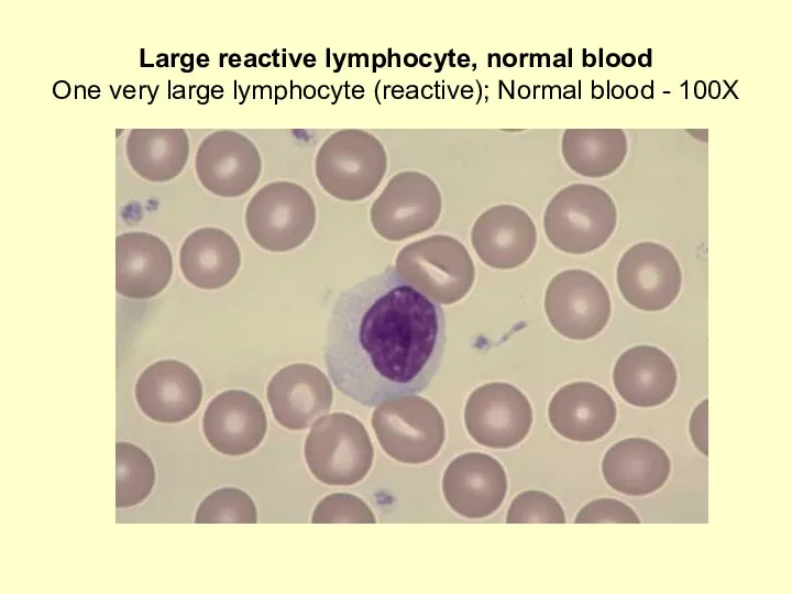 Large reactive lymphocyte, normal blood One very large lymphocyte (reactive); Normal blood - 100X