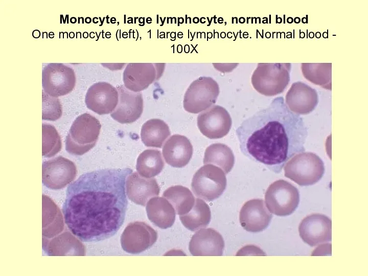 Monocyte, large lymphocyte, normal blood One monocyte (left), 1 large lymphocyte. Normal blood - 100X