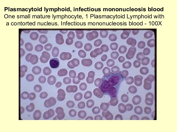 Plasmacytoid lymphoid, infectious mononucleosis blood One small mature lymphocyte, 1