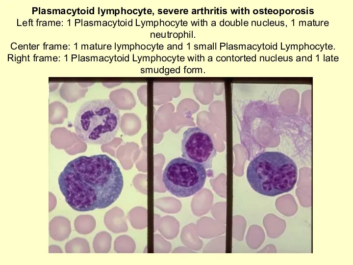 Plasmacytoid lymphocyte, severe arthritis with osteoporosis Left frame: 1 Plasmacytoid