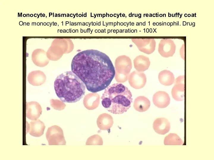 Monocyte, Plasmacytoid Lymphocyte, drug reaction buffy coat One monocyte, 1