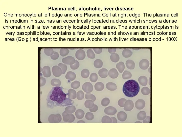 Plasma cell, alcoholic, liver disease One monocyte at left edge