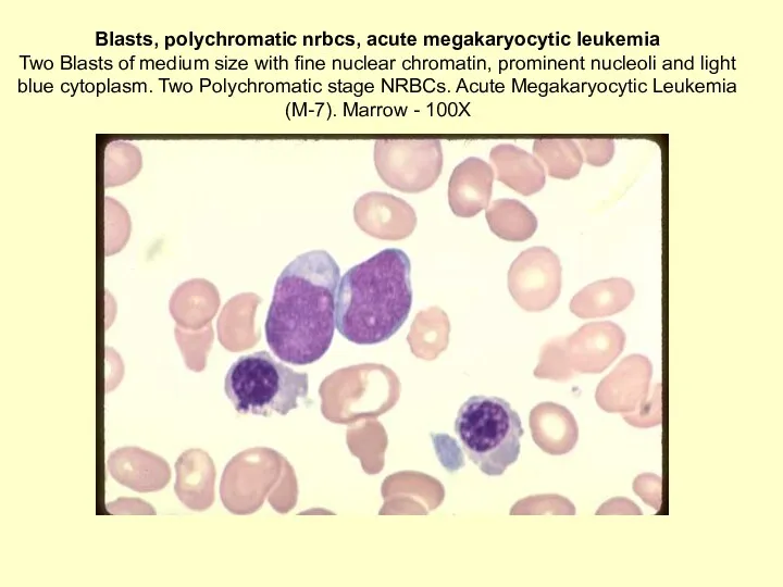 Blasts, polychromatic nrbcs, acute megakaryocytic leukemia Two Blasts of medium