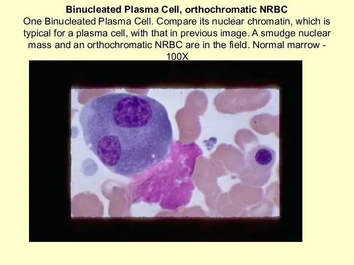 Binucleated Plasma Cell, orthochromatic NRBC One Binucleated Plasma Cell. Compare