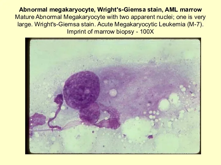 Abnormal megakaryocyte, Wright's-Giemsa stain, AML marrow Mature Abnormal Megakaryocyte with