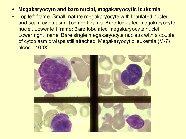 Megakaryocyte and bare nuclei, megakaryocytic leukemia Top left frame: Small