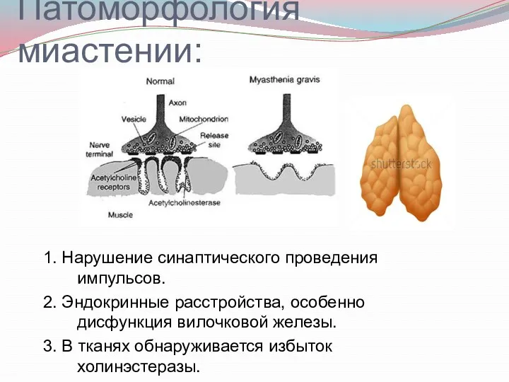 Патоморфология миастении: 1. Нарушение синаптического проведения импульсов. 2. Эндокринные расстройства,