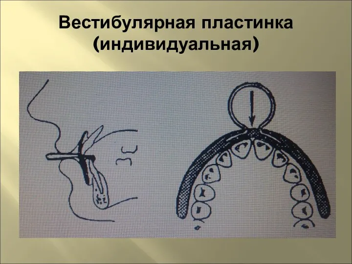 Вестибулярная пластинка (индивидуальная)