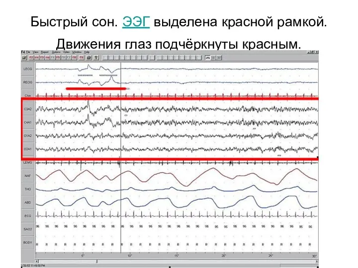 Быстрый сон. ЭЭГ выделена красной рамкой. Движения глаз подчёркнуты красным.