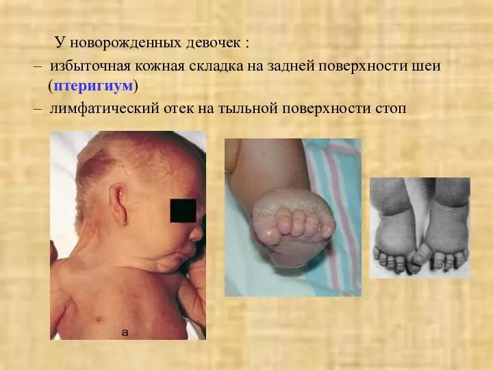 У новорожденных девочек : – избыточная кожная складка на задней поверхности шеи (птеригиум)