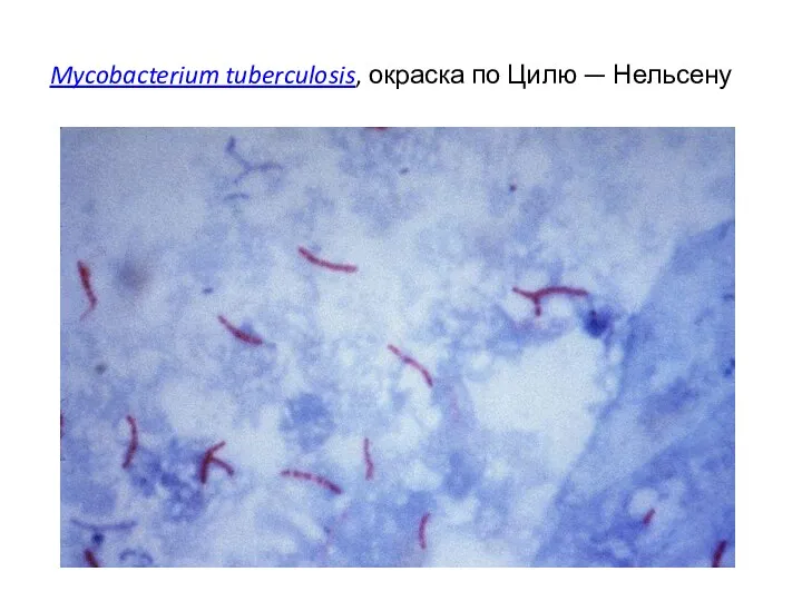 Mycobacterium tuberculosis, окраска по Цилю — Нельсену