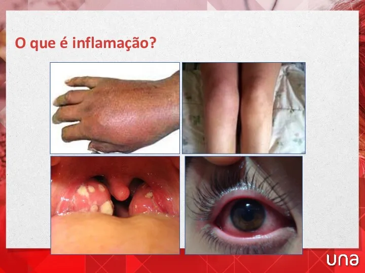 O que é inflamação?