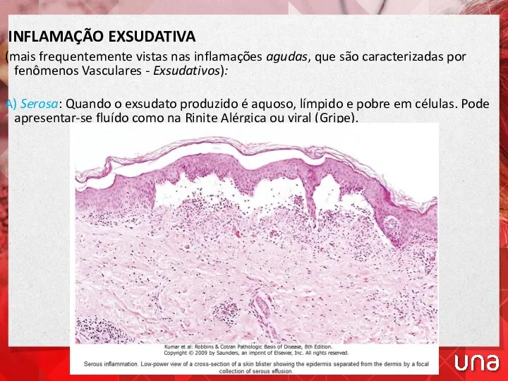 INFLAMAÇÃO EXSUDATIVA (mais frequentemente vistas nas inflamações agudas, que são