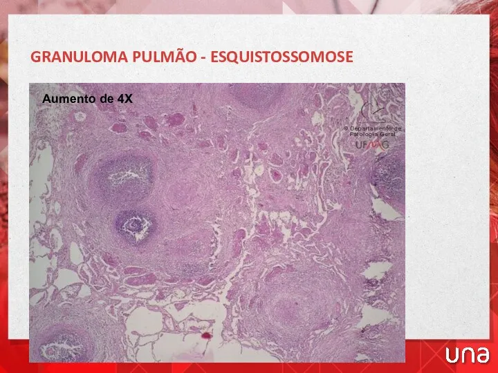 Aumento de 4X GRANULOMA PULMÃO - ESQUISTOSSOMOSE