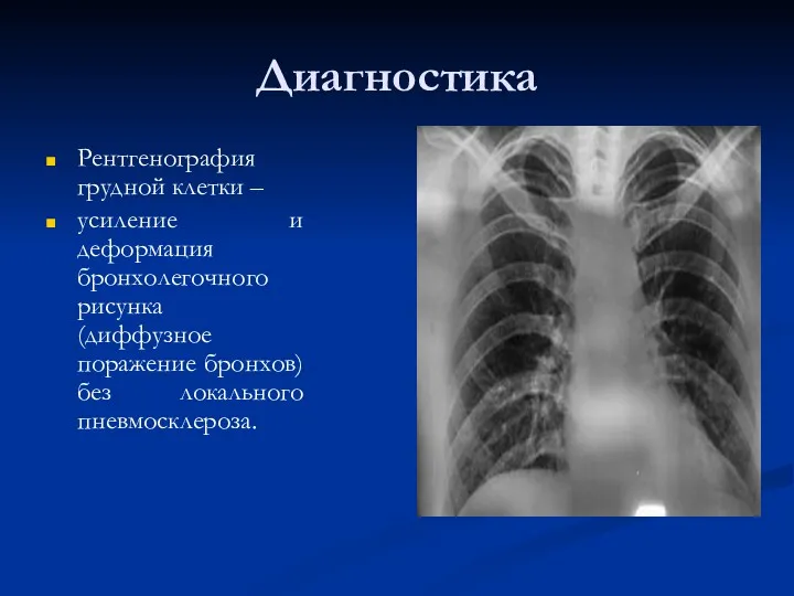 Диагностика Рентгенография грудной клетки – усиление и деформация бронхолегочного рисунка (диффузное поражение бронхов) без локального пневмосклероза.