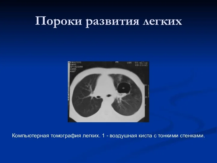 Пороки развития легких Компьютерная томография легких. 1 - воздушная киста с тонкими стенками.