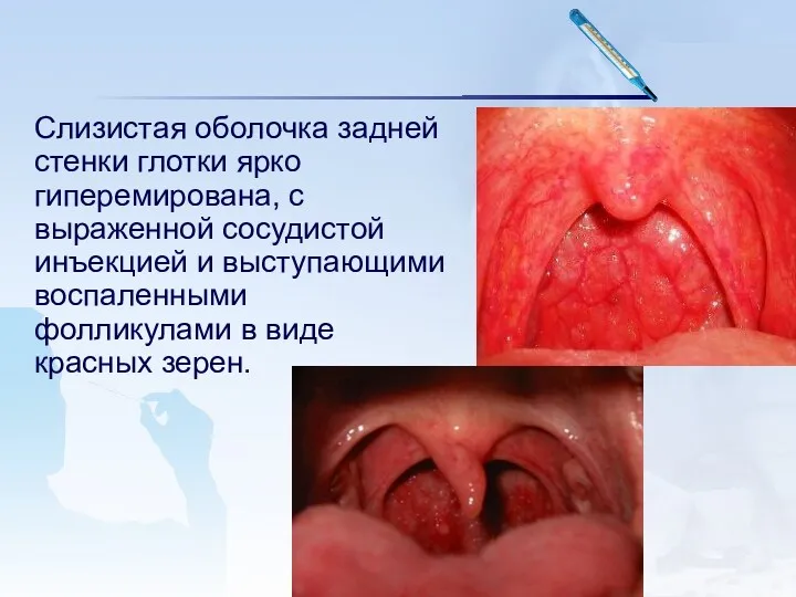 Слизистая оболочка задней стенки глотки ярко гиперемирована, с выраженной сосудистой