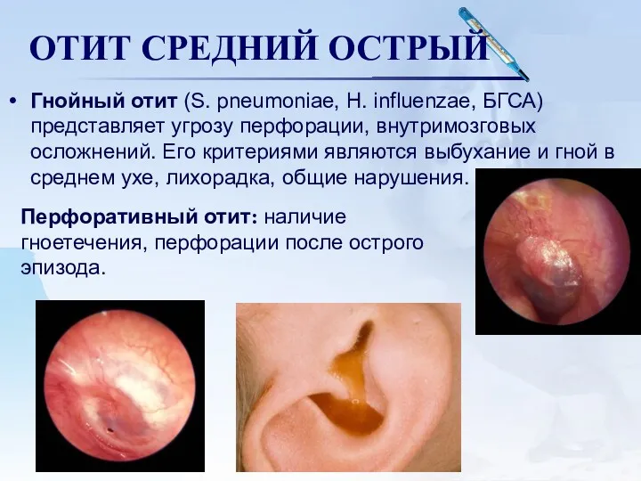 ОТИТ СРЕДНИЙ ОСТРЫЙ Гнойный отит (S. pneumoniae, H. influenzae, БГСА)