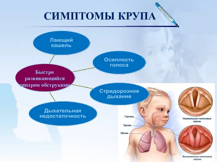 СИМПТОМЫ КРУПА Быстро развивающийся синдром обструкции