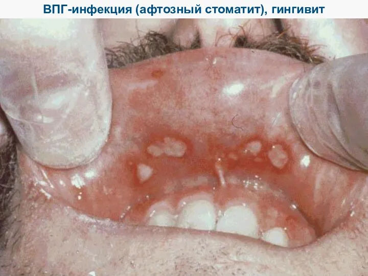 ВПГ-инфекция (афтозный стоматит), гингивит