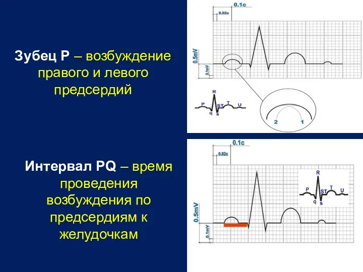 Зубец P – возбуждение правого и левого предсердий Интервал PQ